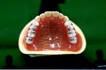 噛める総義歯への対応 